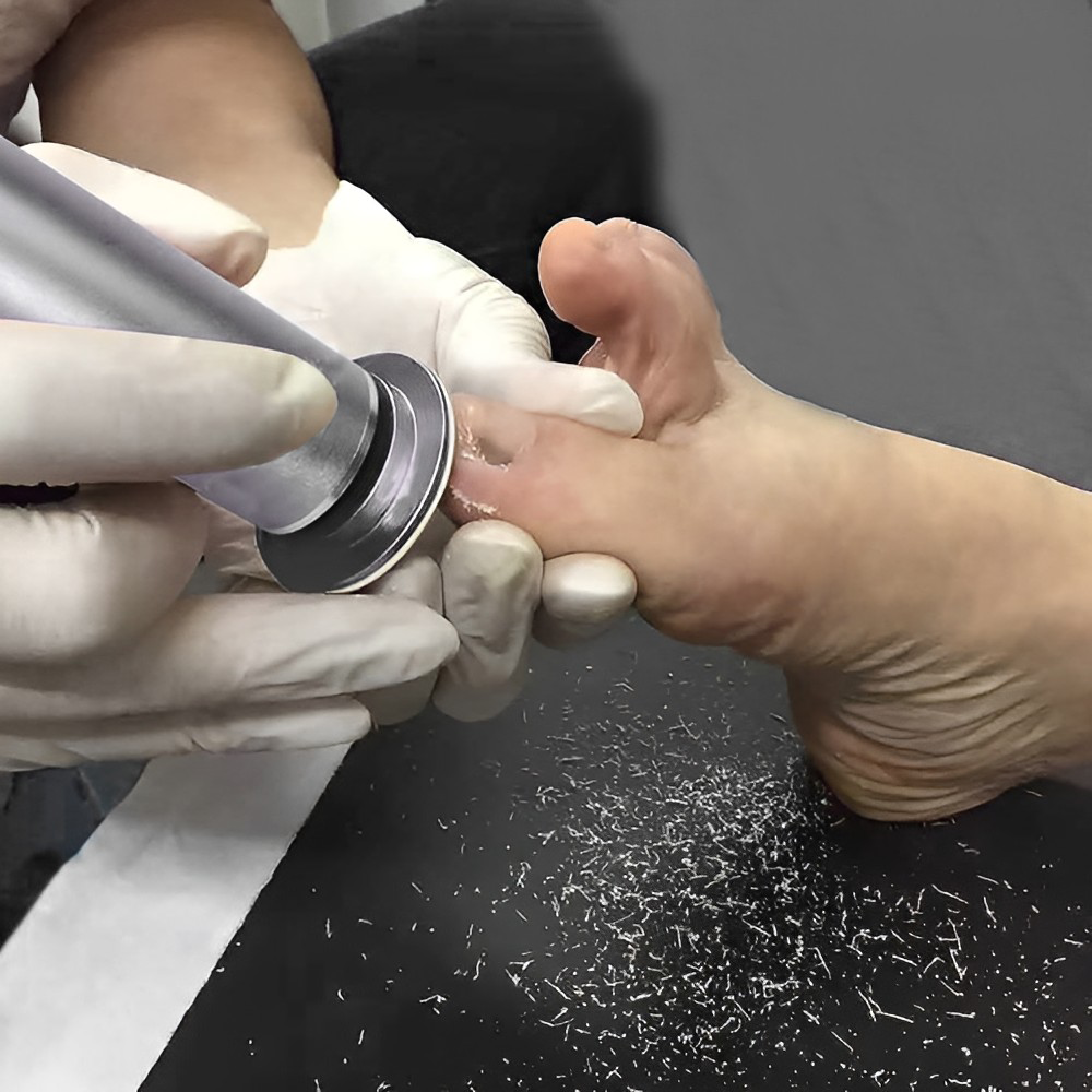 SoleSmooth Professional Electric Callus Remover – Perfect Gift for Silky Smooth Feet